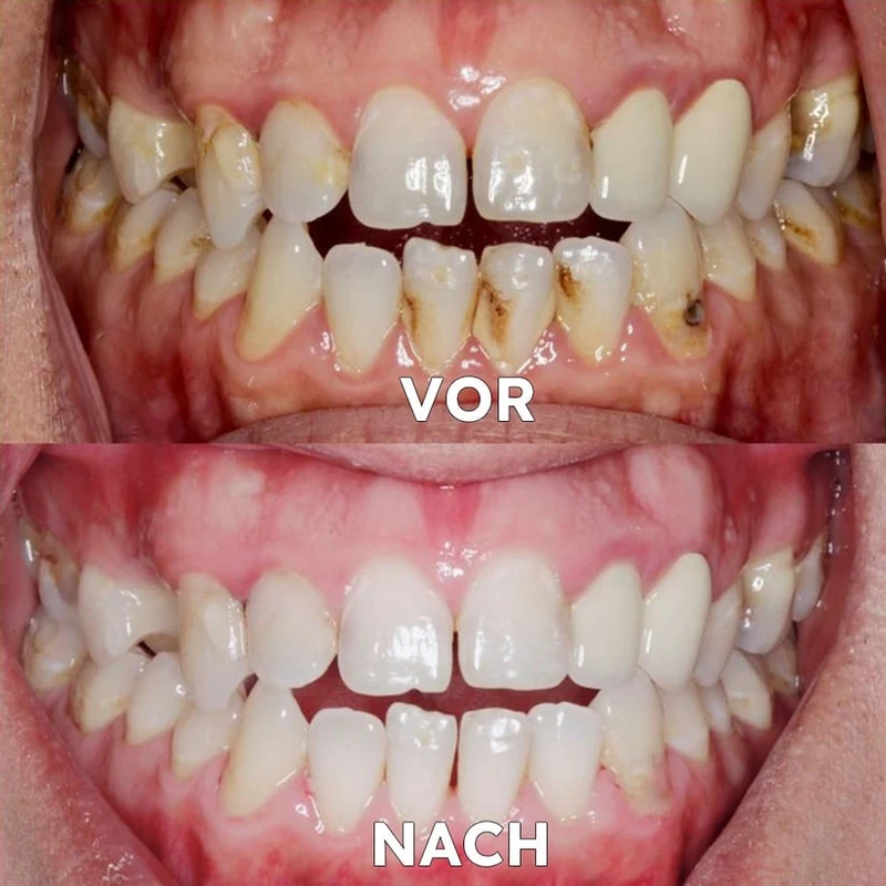 Mineralpulver für Zahnpflege | Zähne Stärken & Schützen | SmileSchutz